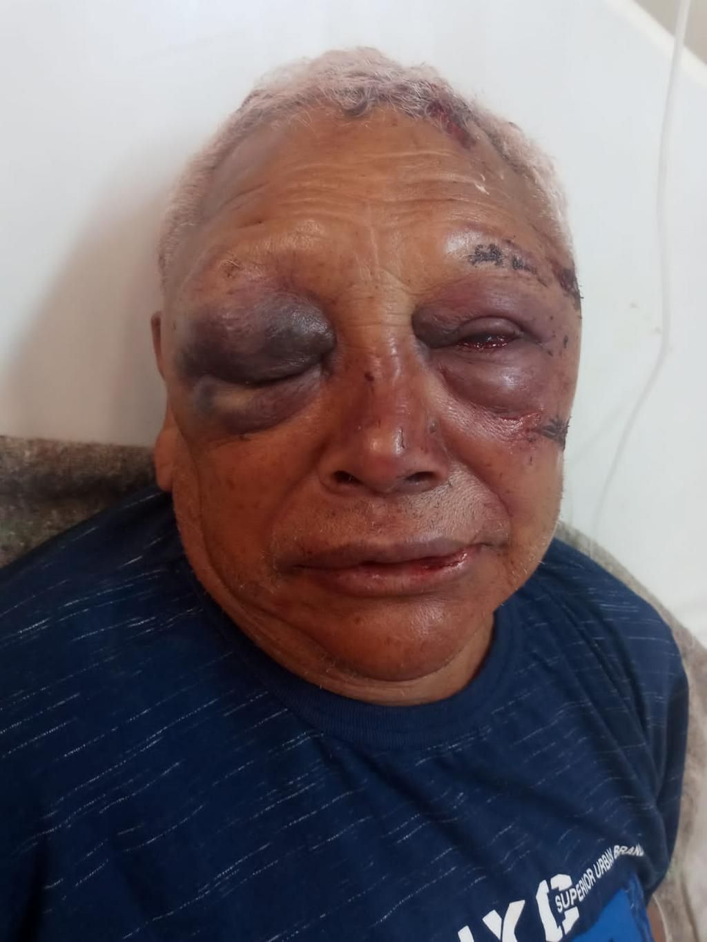 La Plata: En un salvaje asalto le desfiguraron la cara a un jubilado