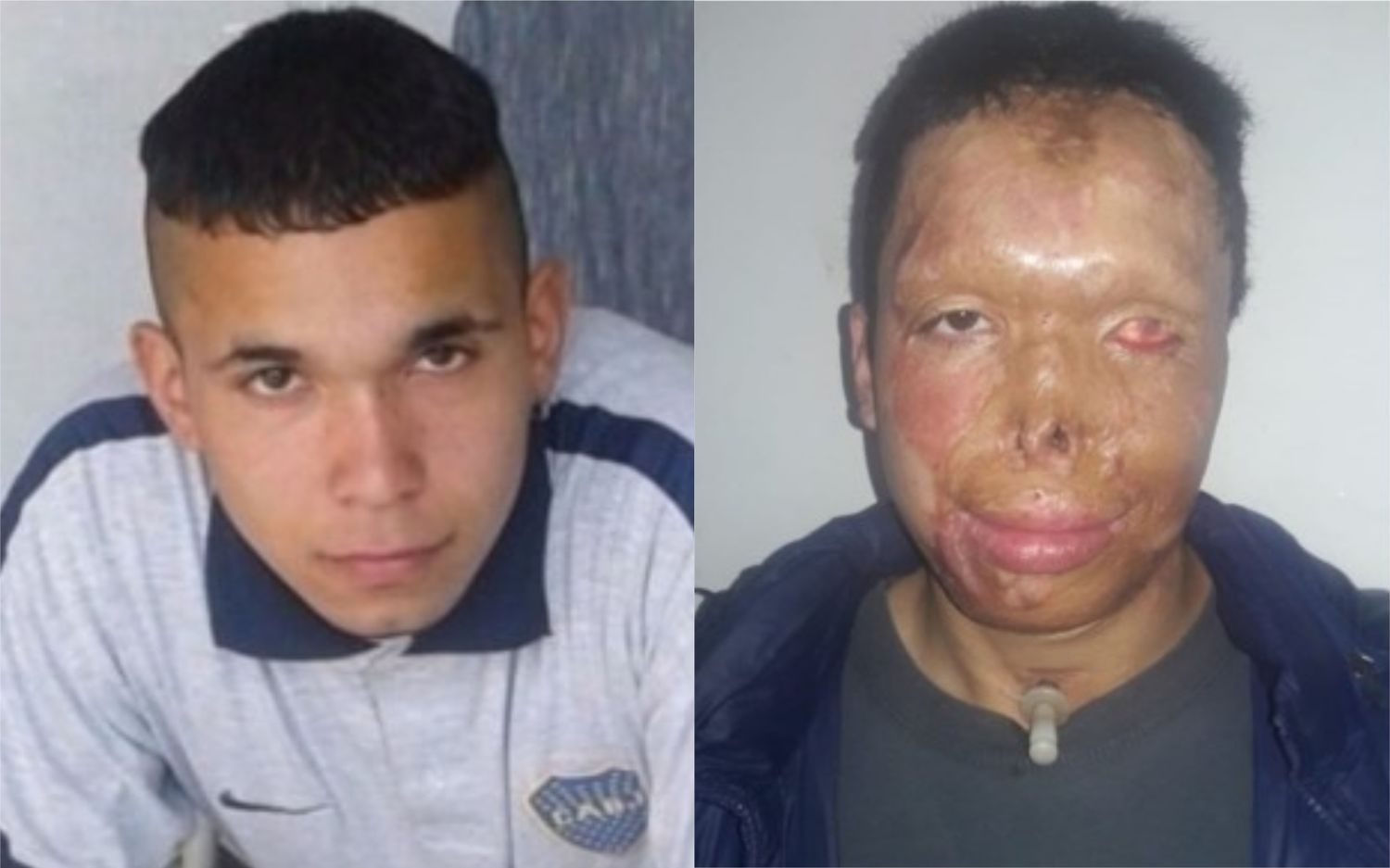 Ituzaingó: Lo quemaron con ácido en la cara y le niegan el certificado de discapacidad