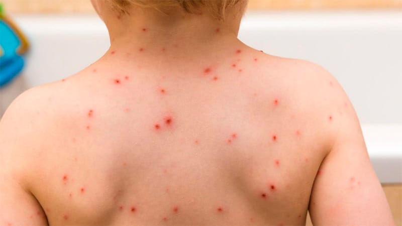 Advierten por rebrote de sarampión: “Es fundamental la vacunación en personas adultas"