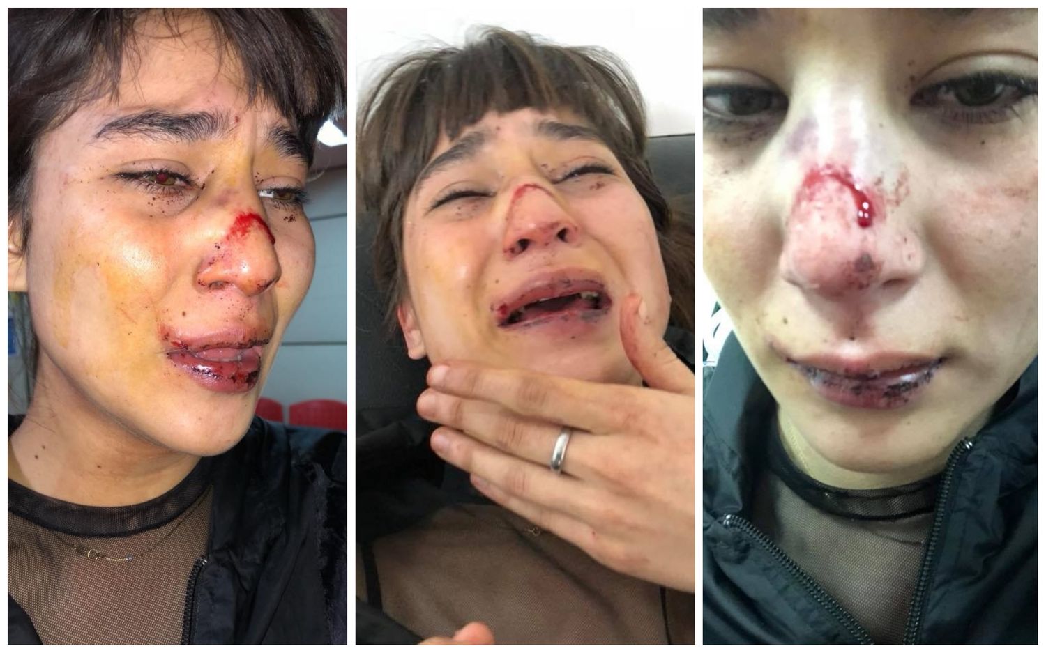 Una joven fue desfigurada por su exnovio a la salida de un boliche en Berazategui