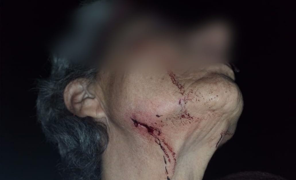 General Pueyrredón: Brutal ataque de pitbulls a una mujer en Mar del Plata