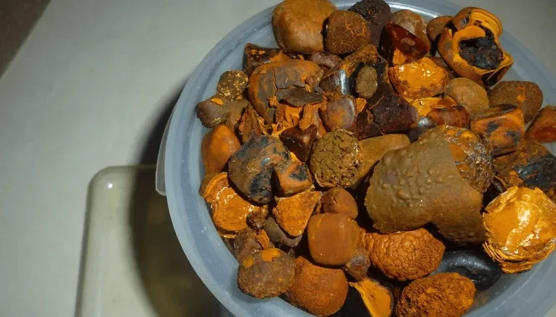 cálculos biliares de vaca